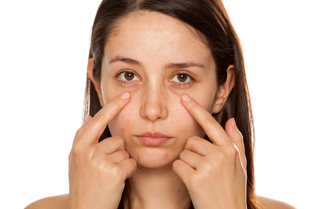 Understanding Dark Circles: What Causes Them and How to Fix Them
