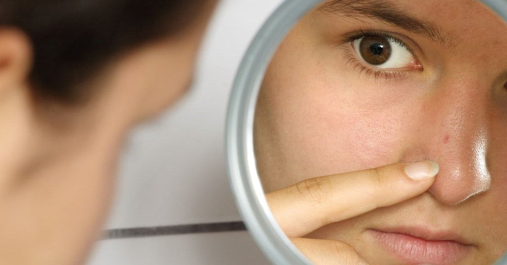 What Makes Blackheads Come Out? And How to Prevent Them From Happening?