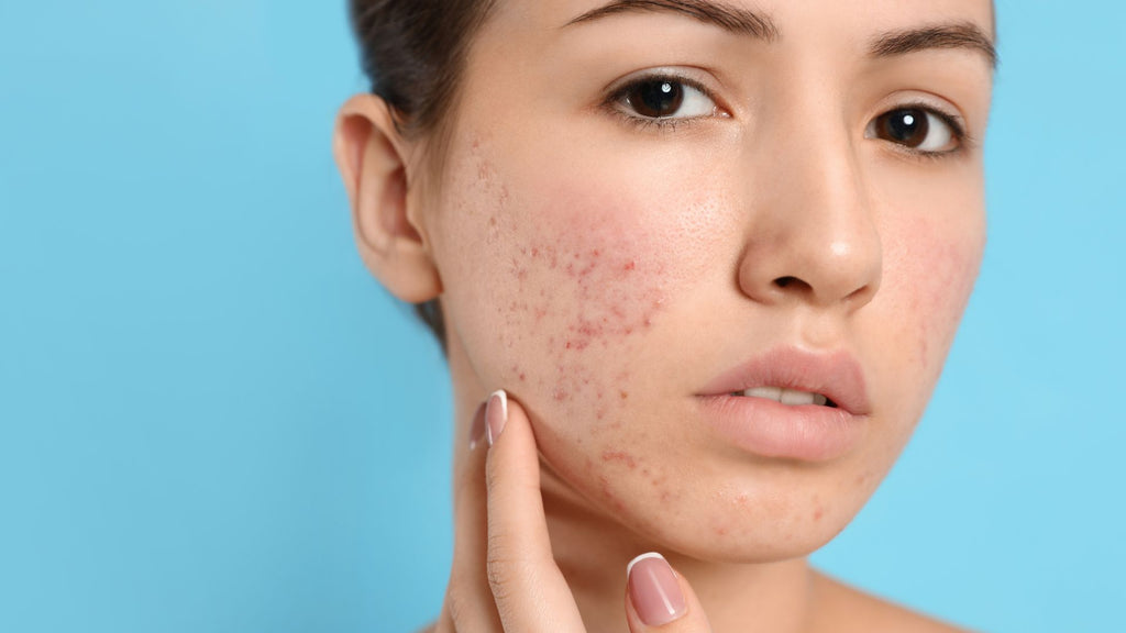 The Complete Skincare Regime for Acne-Prone Skin